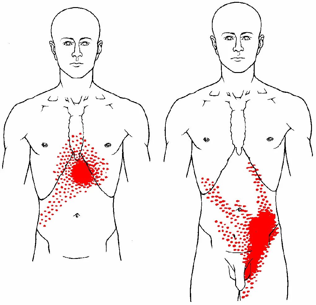 Иррадиация внизу живота. Триггерные точки мышц живота. Триггерные точки косых мышц живота. Фибромиалгия триггерные точки схема. Миофасциальные болевые триггерные точки тела человека.