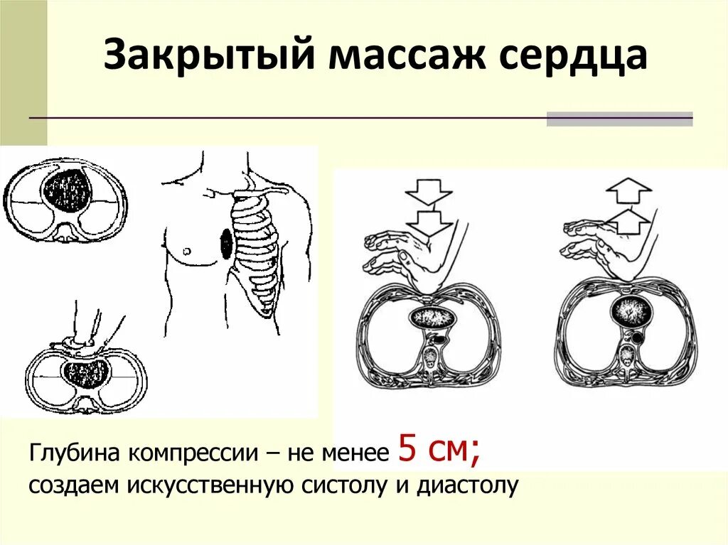 Частота закрытого массажа сердца. Закрытый массаж сердца. Закрытом массаже сердца. Закрытого массажа сердца. Принцип закрытого массажа сердца.