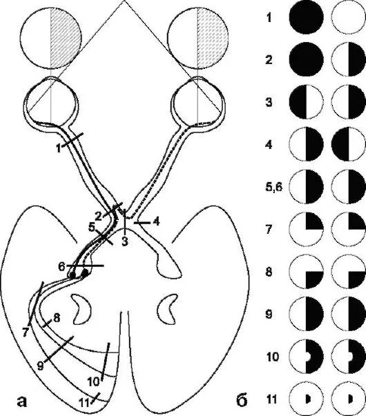 Зрительный нерв неврология схема. Выпадение полей зрения схема. Зарисовать выпадение полей зрения при поражении. Поражение зрительного нерва гемианопсия. Монимен
