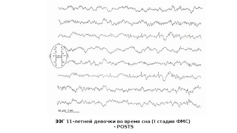 Луки ээг. ЭЭГ волны. Графоэлементы ЭЭГ. ЭЭГ норма. Лямбда волны на ЭЭГ.