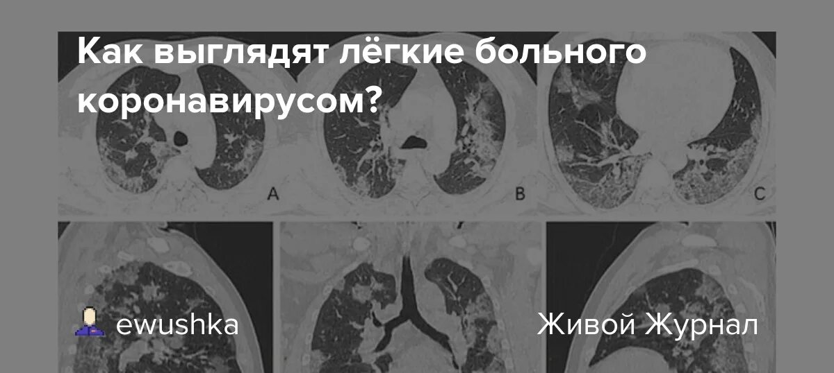 Ковид восстановление легких. Легкие на кт при коронавирусе. Кт легких здорового человека. Снимок кт легких здорового человека.