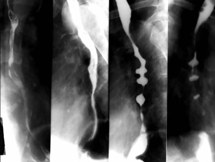 Пищевода с барием. Контрастирование пищевода рентген. Скопия пищевода рентген. Стриктура пищевода рентген. Дисфагия пищевода рентген.