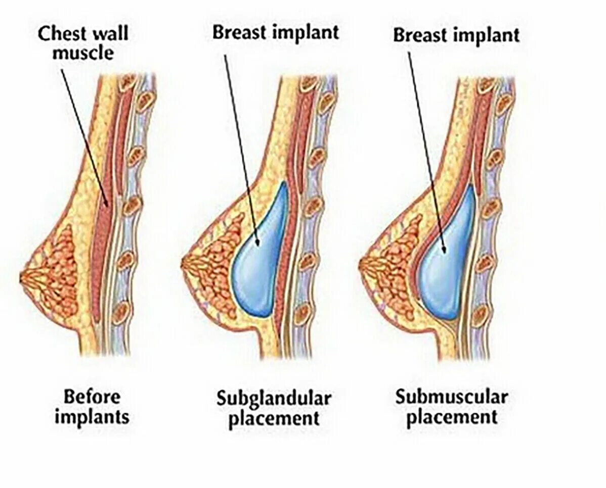 Импланты грудных желез. Имплант под грудную мышцу. Импланты молочной железы под мышцей. Типы имплантов грудных.