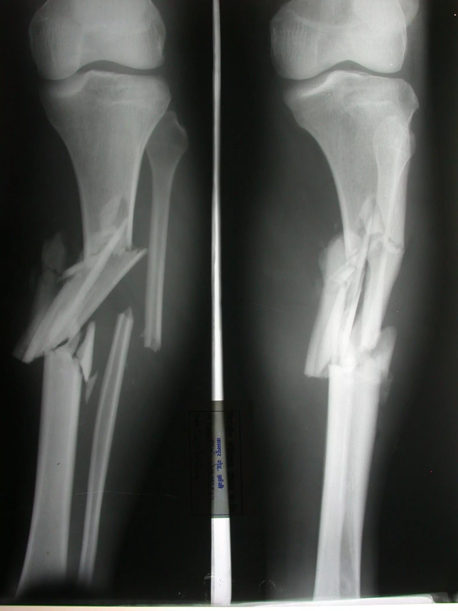 Открытый перелом кости руки. Рентгенограмма перелом кости. Перелом лучевой и берцовой кости. Открытый перелом берцовой кости.
