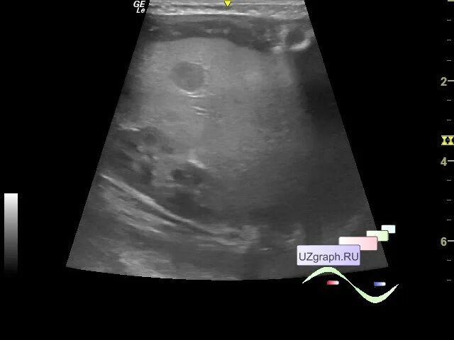 Очаговые изменения почки. УЗИ. УЗИ кишечника (сонография). Эхограмма печени с метастазами. Киста брюшной полости на УЗИ.