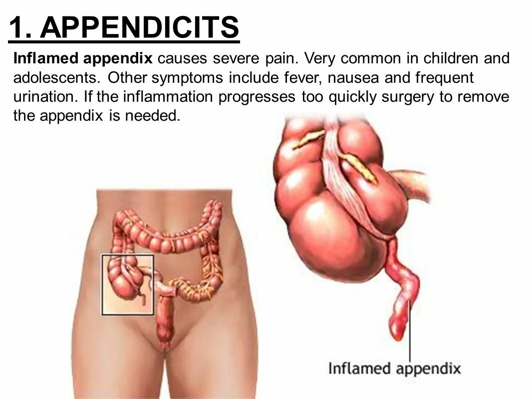 Анатомия человека аппендикс. Аппендицит воспаление кишечника. Аппендикс воспаление операция. Анатомия человека органы аппендикс. Симптомы операция кишечнике