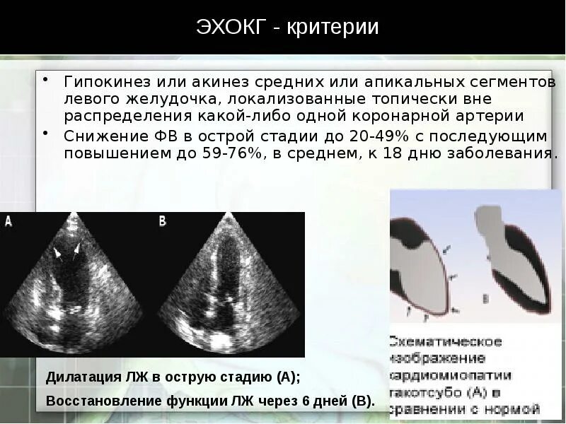 Гипокинез среднего сегмента. Гипокинез сегментов левого желудочка. дкмп эхокг критерии. кардиомиопатии на эхокг. зоны гипокинеза на эхо.
