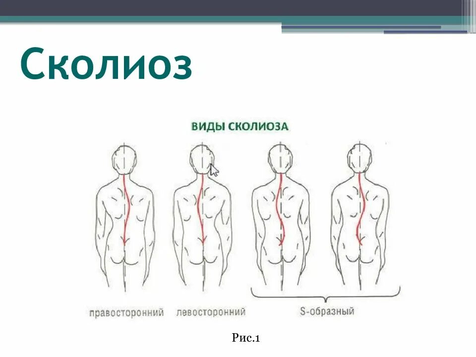 Отдел вправо. Правосторонний s образный сколиоз. Грудной правосторонний с образный сколиоз 1 степени. Левосторонний сколиоз грудного отдела степени. Искривление позвоночника, s образный сколиоз.