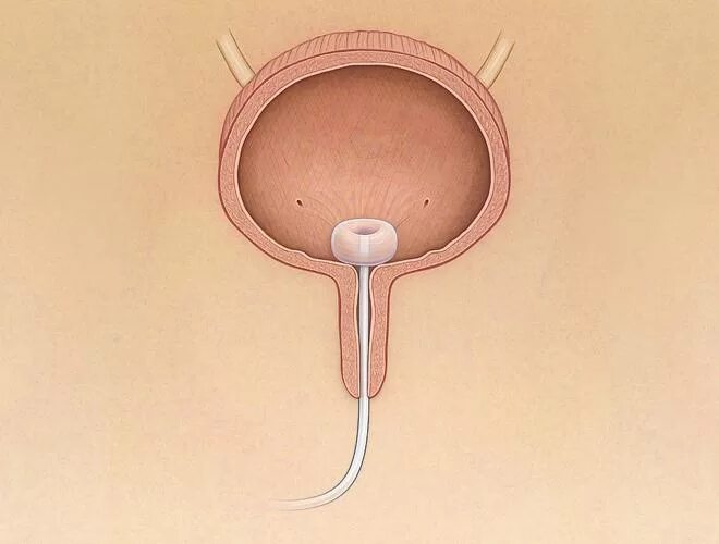 Задержка мочи в домашних условиях. Цистостома мочевого пузыря. Цистостома мочевого пузыря катетер. Опорожнение мочевого пузыря.