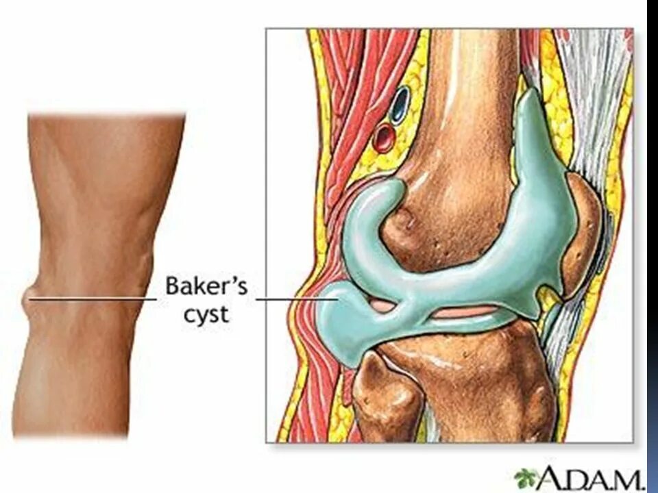 Ноги при грыже позвоночника. Защемило седалищный нерв. Грыжа в ноге как лечить. Подколенная грыжа бехтерева. Грыжа позвоночника и ишиалгия.