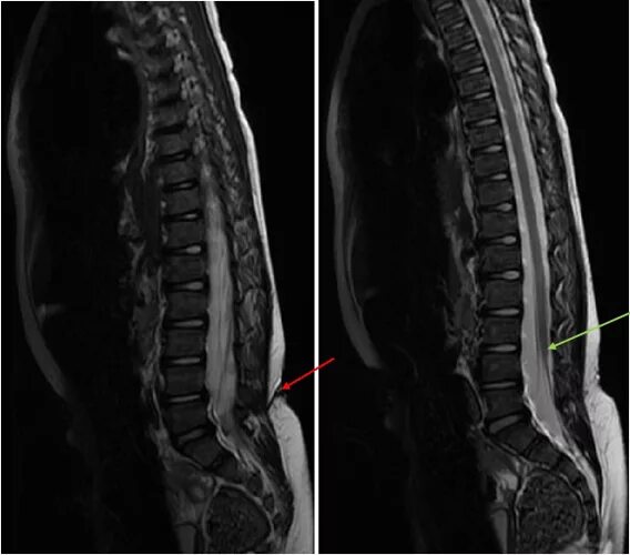 Тетеринг синдром спинного мозга. Липома терминальной нити синдром фиксированного спинного мозга. Липома терминальной нити l2 l4. Липома терминальной нити спинного мозга на мрт.