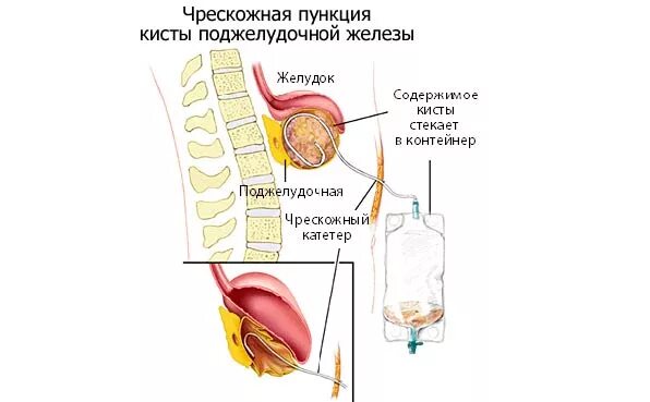 Делают ли операцию на поджелудочную. Операции при кистах поджелудочной железы. Дренирование псевдокисты поджелудочной железы. Операции внутреннего дренирования псевдокист поджелудочной железы. Дренирование кисты поджелудочной.