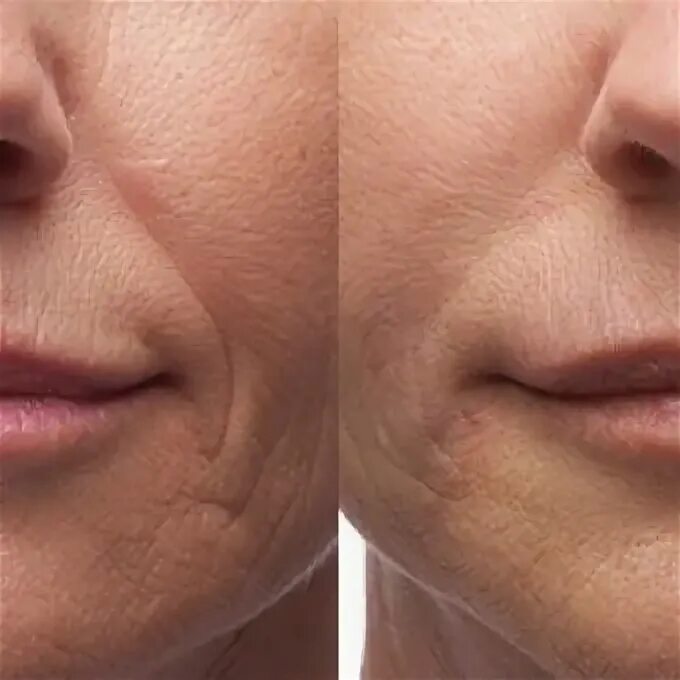 Бланширование белотеро софт. Бланширование отзывы. Блашинг белотеро. Бланширование морщин лица что это. Бланширование гиалуроновой кислотой морщин.