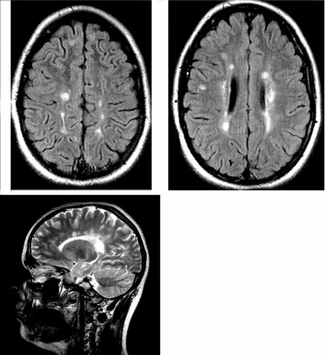 Демиелинизация головного мозга мрт. Рассеянный склероз на мрт т1. Рассеянный склероз на мрт головного мозга. Очаги демиелинизации головного мозга на мрт. Демиелинизация головного