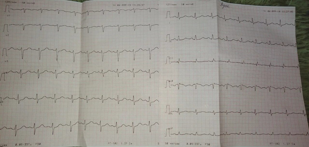 Депрессия st сегмента v5. Депрессия сегмента st в v4-v6. депрессия st v3,v4,v5,v6. депрессия st на экг в v5 v6. провал сегмента st.