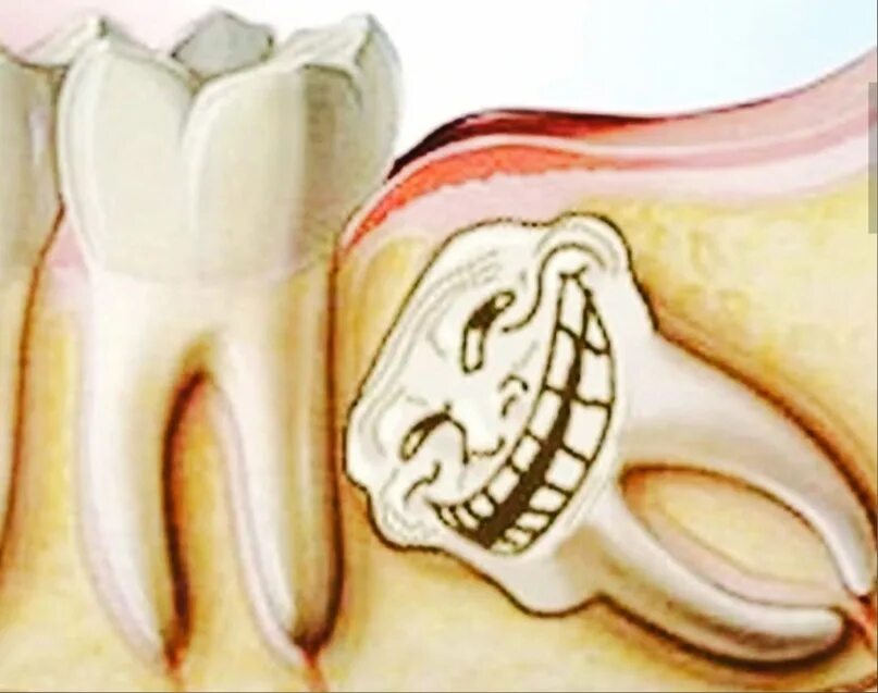 Зуб 8 нижний. Ретинированного зуба противопоказано. Кнопка на ретинированный зуб. Язычный Тип зуба мудрости.