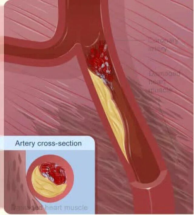 Атеросклероз коронарных артерий. Инфаркт миокарда анимация. Сердечный тромбоз