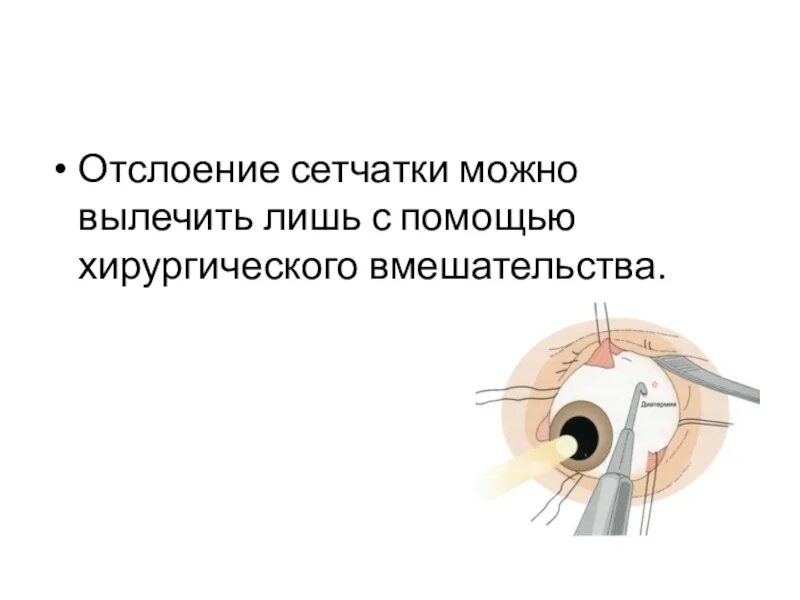 Неопластическая отслойка сетчатки. Отхождение сетчатки глаза. Отслойка сетчатки симптомы.