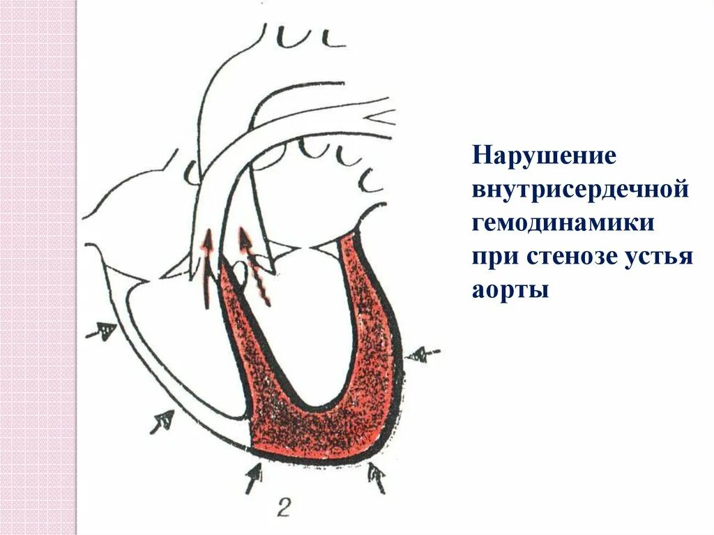 Внутрисердечная гемодинамика. Гемодинамика при аортальном стенозе схема. Аортальный стеноз гемодинамика. Аортальный стеноз гемодинамика схема. Аортал стеноз гемодинамика.