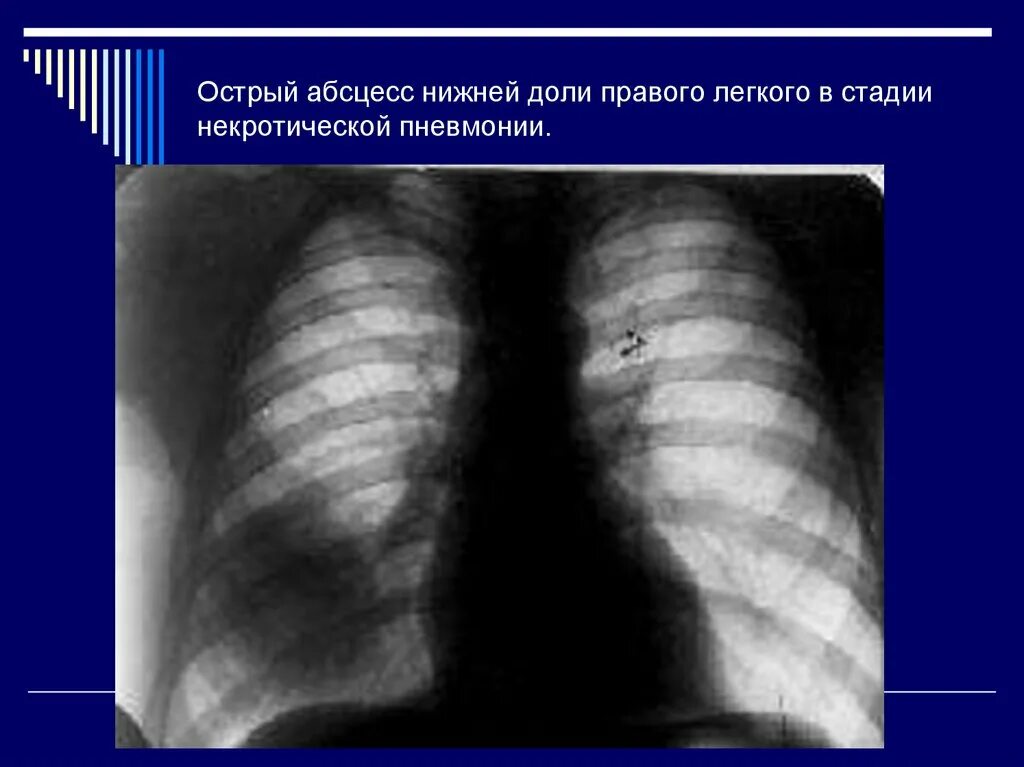 Абсцесс легкого пневмония рентген. Дренированный абсцесс легкого. Пневмония нижней доли правого легкого рентген. Стадии острого абсцесса легкого. Пневмония в нижней доле правого легкого