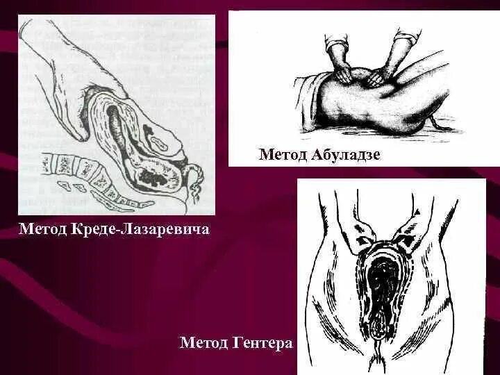 Абуладзе Гентера Креде-Лазаревича. Метод Креде-Лазаревича Абуладзе. Абуладзе отделение плаценты. Методы Гентера и Креде-Лазаревича.