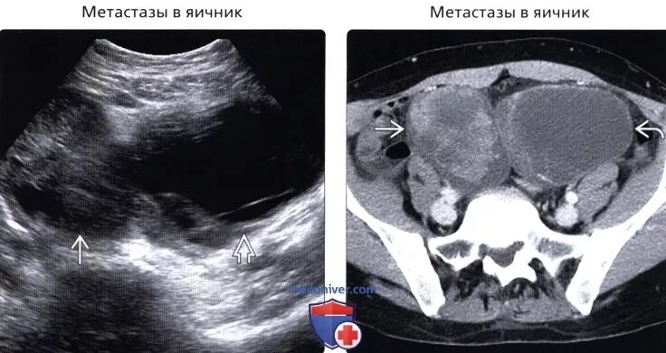 2 в яичниках образуются. Кистозно-солидная опухоль яичника УЗИ. Кистозно-Солидное образование. Кистозно-Солидное образование яичника УЗИ.