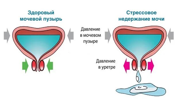 Непроизвольное Мочеиспускание У Женщин Во Время Секса