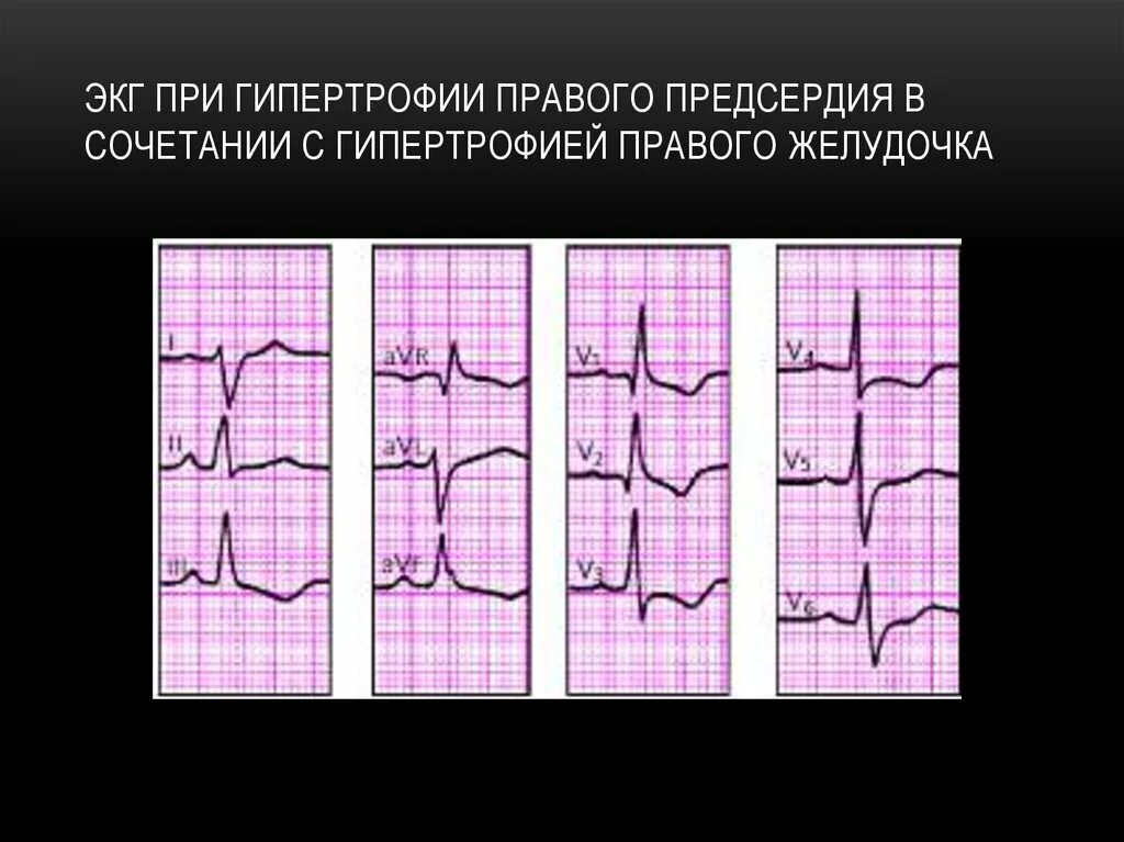 Глж на экг что это значит. Гипертрофия правого предсердия и желудочка на ЭКГ. Гипертрофия миокарда предсердий ЭКГ. ЭКГ гипертрофия правого желудочка ЭКГ. Гипертрофия предсердий на ЭКГ.