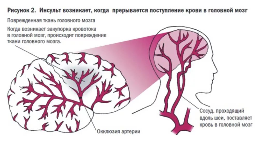 Имеет крови мозга и. Закупорка сосудов головного мозга инсульт. Инсульт рисунок.