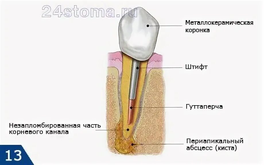 Как вкручивают штифт. Культевая вкладка со штифтом.