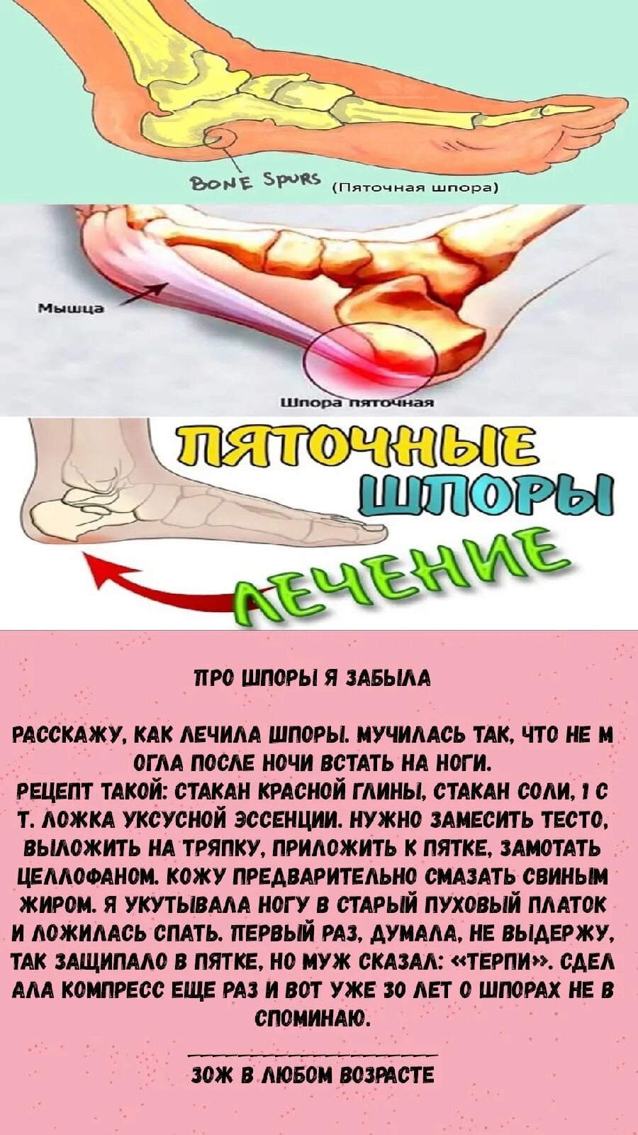 Шпора пяточная лечение у мужчин