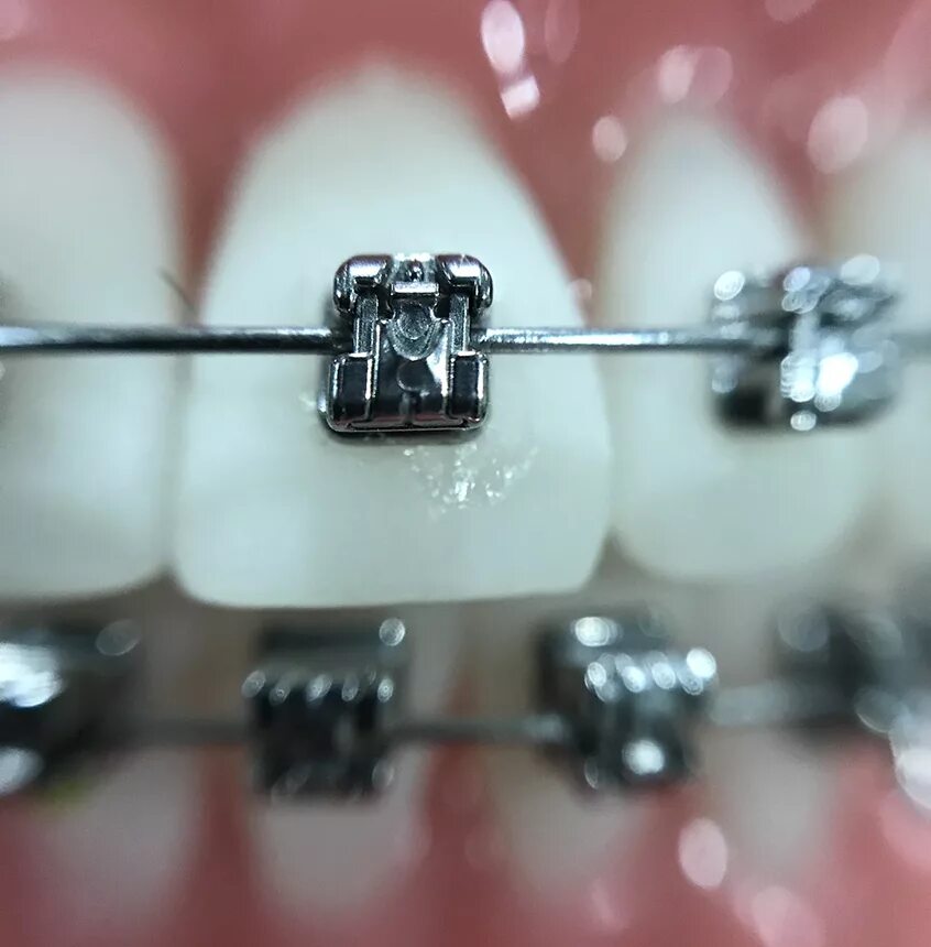 Как выглядят брекеты. Брекеты американ ортодонтикс металлические. american orthodontics брекеты самолигирующие.
