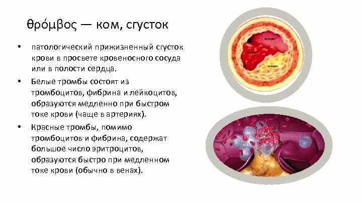 Тромб состоит из тромбоцитов, фибрина и лейкоцитов:. (Фибрин кровяной сгусток. Тромбоз определение