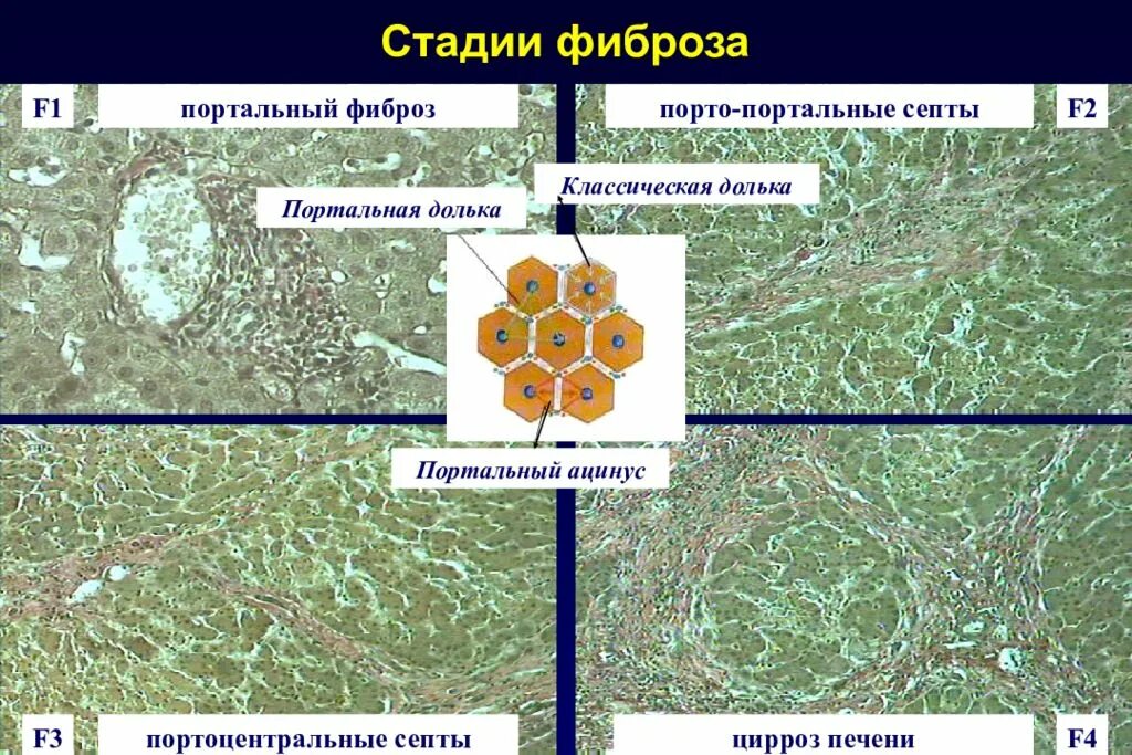 Стадии гепатита печени. Цирроз печени гистология. Фиброз портальных трактов печени. Разрастание соединительной ткани в печени.