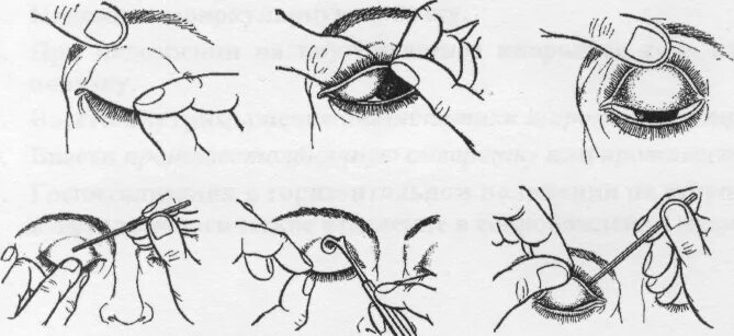 Выворот верхнего века алгоритм. Халязион массаж верхнего века. Массаж при блефарите века стеклянной палочкой. Массаж век при блефарите схема.