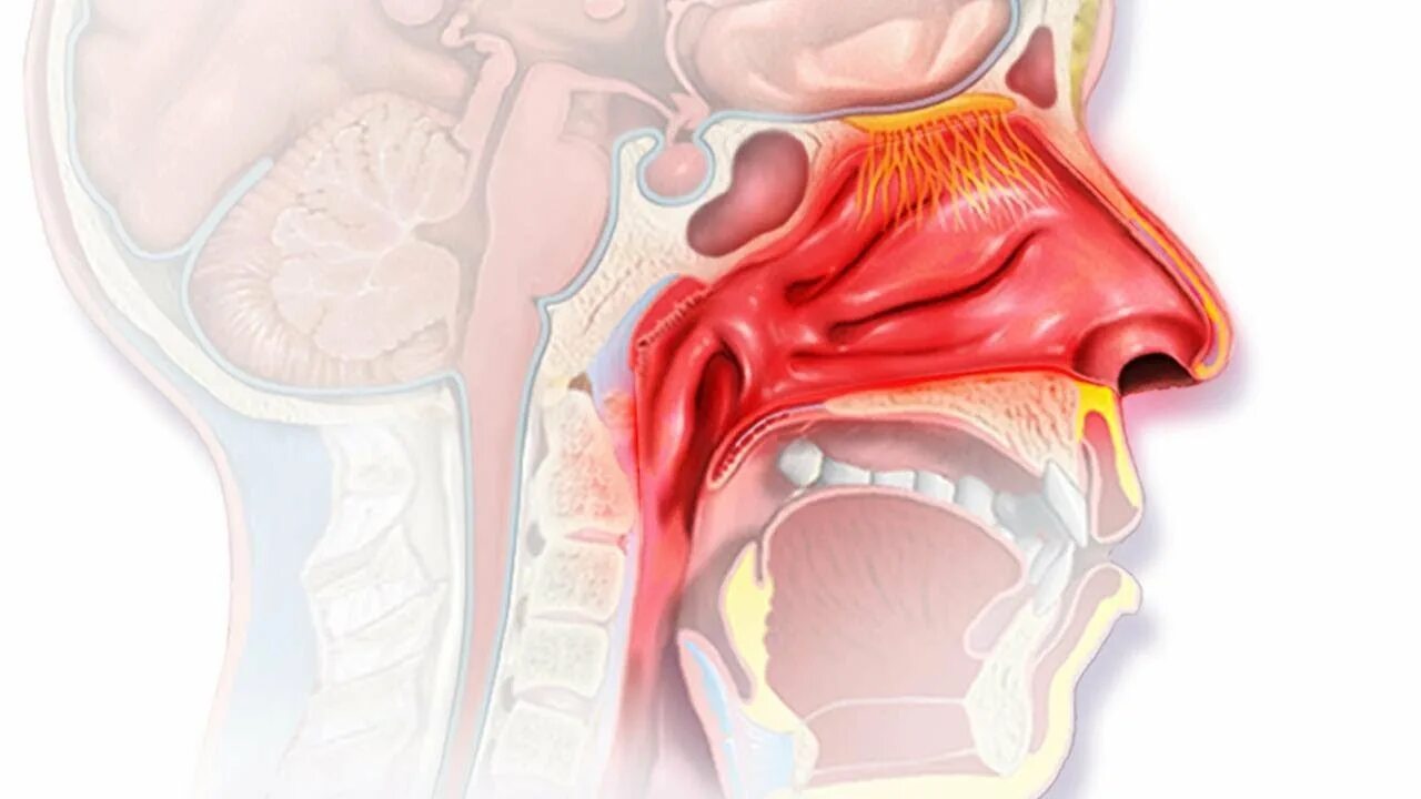 Атрофический ринит нос. Острый ринит и ринофарингит. Аллергический ринит слизистая. Острый катаральный ринит
