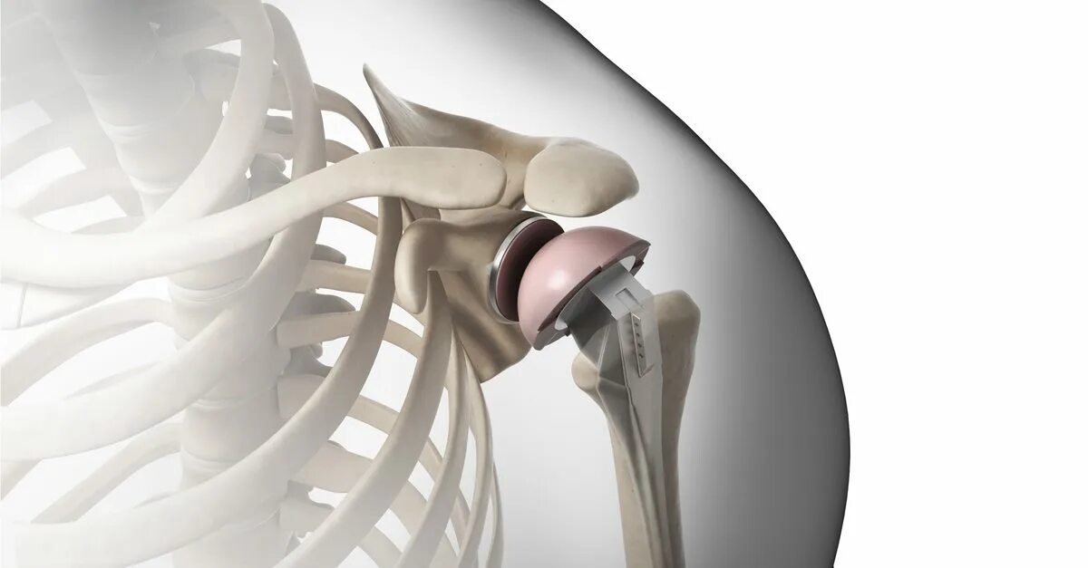 Операция по замене плечевого сустава. Эндопротез плечевого сустава. Эндопротез плечевого сустава Stryker. Артропластика плечевого сустава. Эндопротезирование плечевого сустава реабилитация.