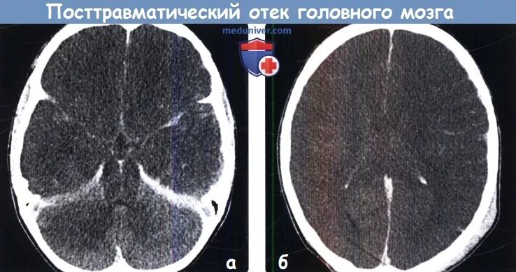 Оттек головного мозга