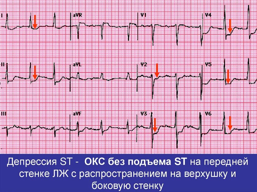 ЭКГ Окс без подъема сегмента St. Острый коронарный синдром без подъема сегмента St ЭКГ. ЭКГ острый коронарный синдром инфаркт миокарда. Подъем сегмента St в AVR на ЭКГ. Без подъема st на экг