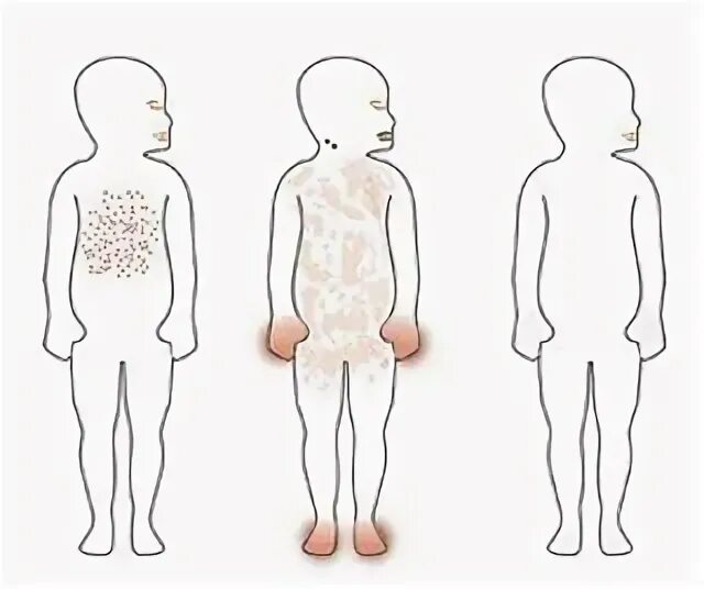 What does that rash mean? Childhood disease, Heat rash, Baby rash