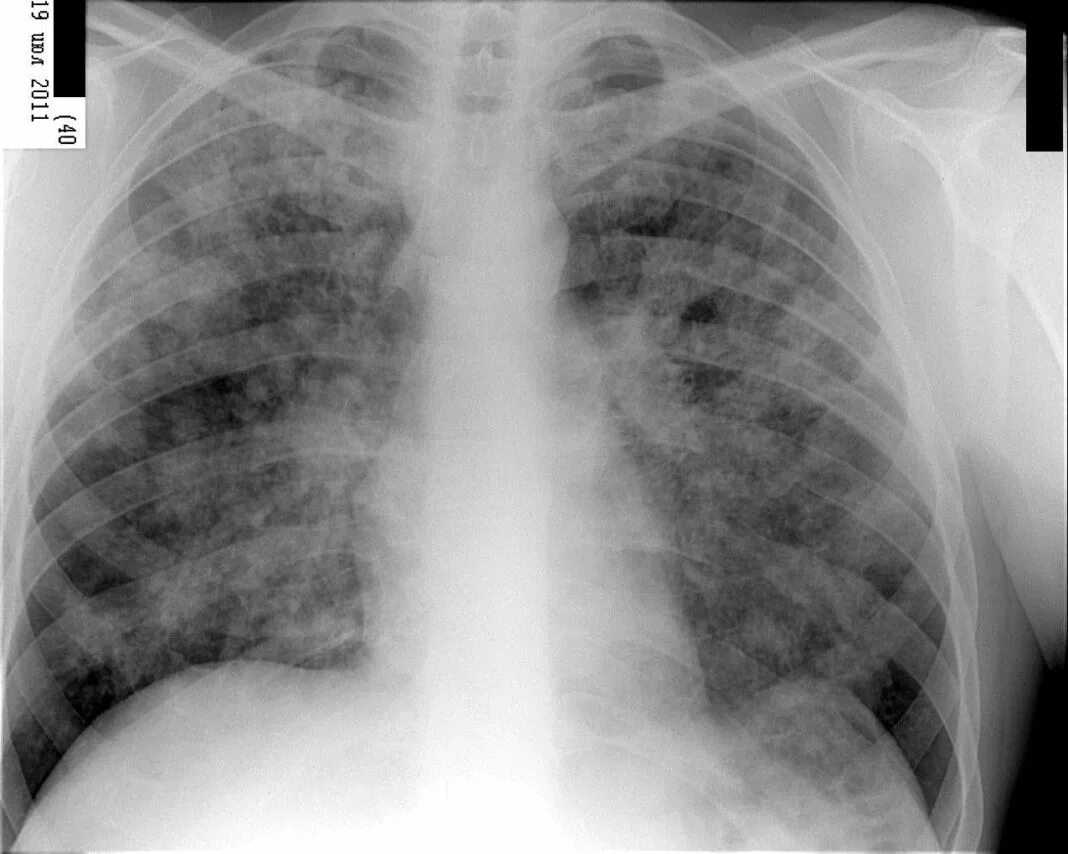 Туберкулез рентгенограмма