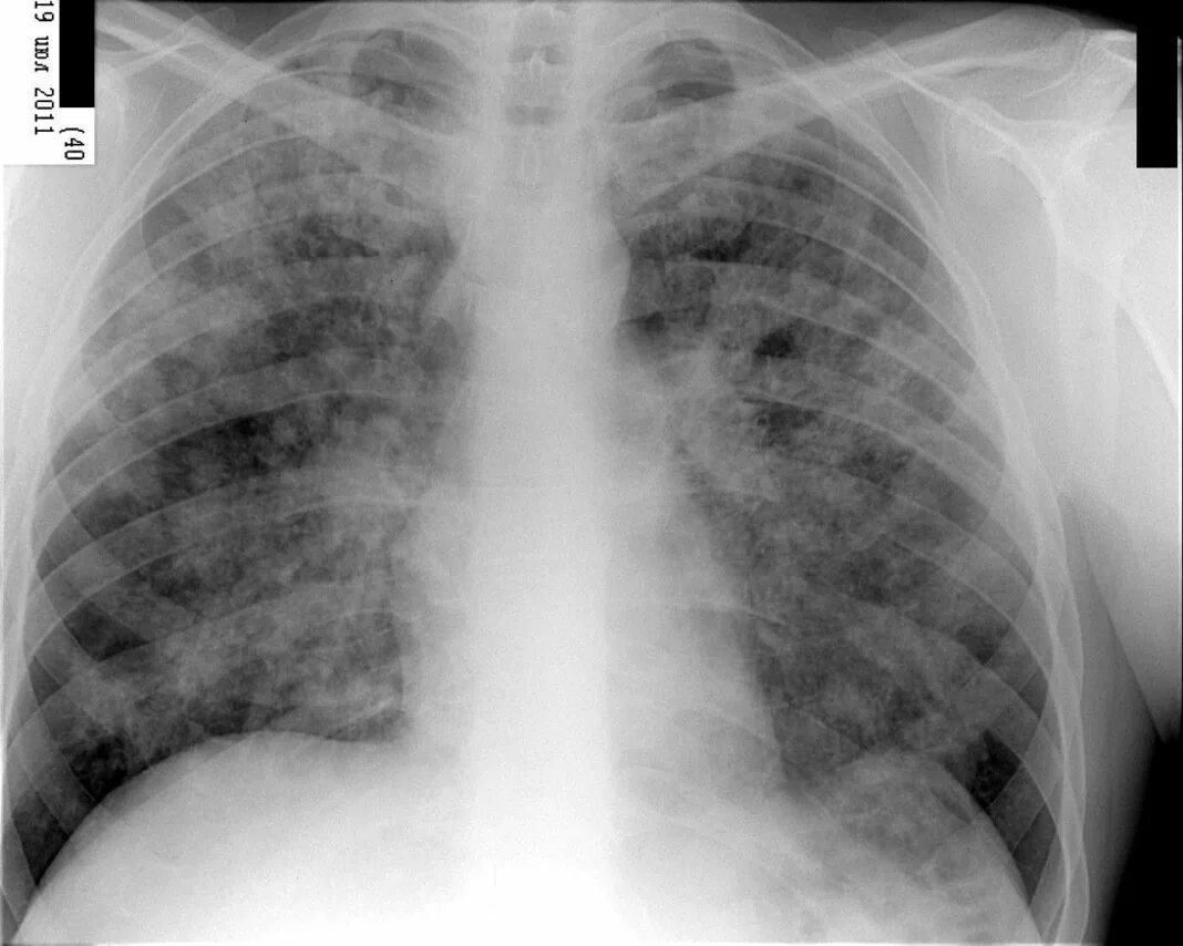 Очаговый бронхит. Туберкулез легкого рентгенограмма. Крупноочаговая пневмония рентген. Мелкоочаговая пневмония рентген. Туберкулез легких рентген.