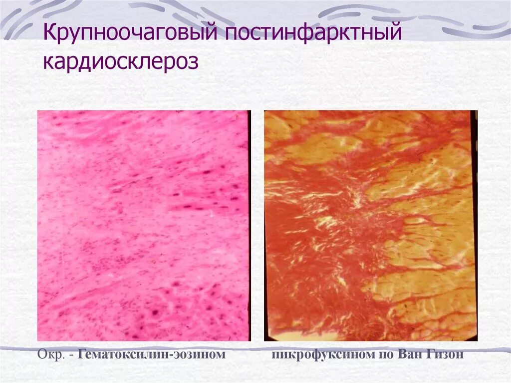 Диффузный мелкоочаговый. Постинфарктный кардиосклероз Ван Гизон микропрепараты. Постинфарктный кардиосклероз окраска гематоксилином и эозином. Диффузный мелкоочаговый кардиосклероз микропрепарат. Инфаркт миокарда гемотаксилинэозин.