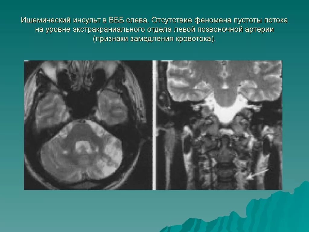 Вертебро базилярная инсульт. Ишемический ОНМК мрт. Вертебробазилярный бассейн инсульт ишемический. Ишемический инсульт мрт. Ишемический инсульт в вертебро-базилярном бассейне кт.