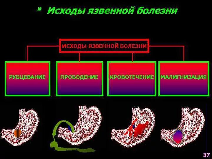 Малигнизация язвенной болезни. Малигнизация язвенной болезни желудка. Малигнизация язвы желудка классификация.