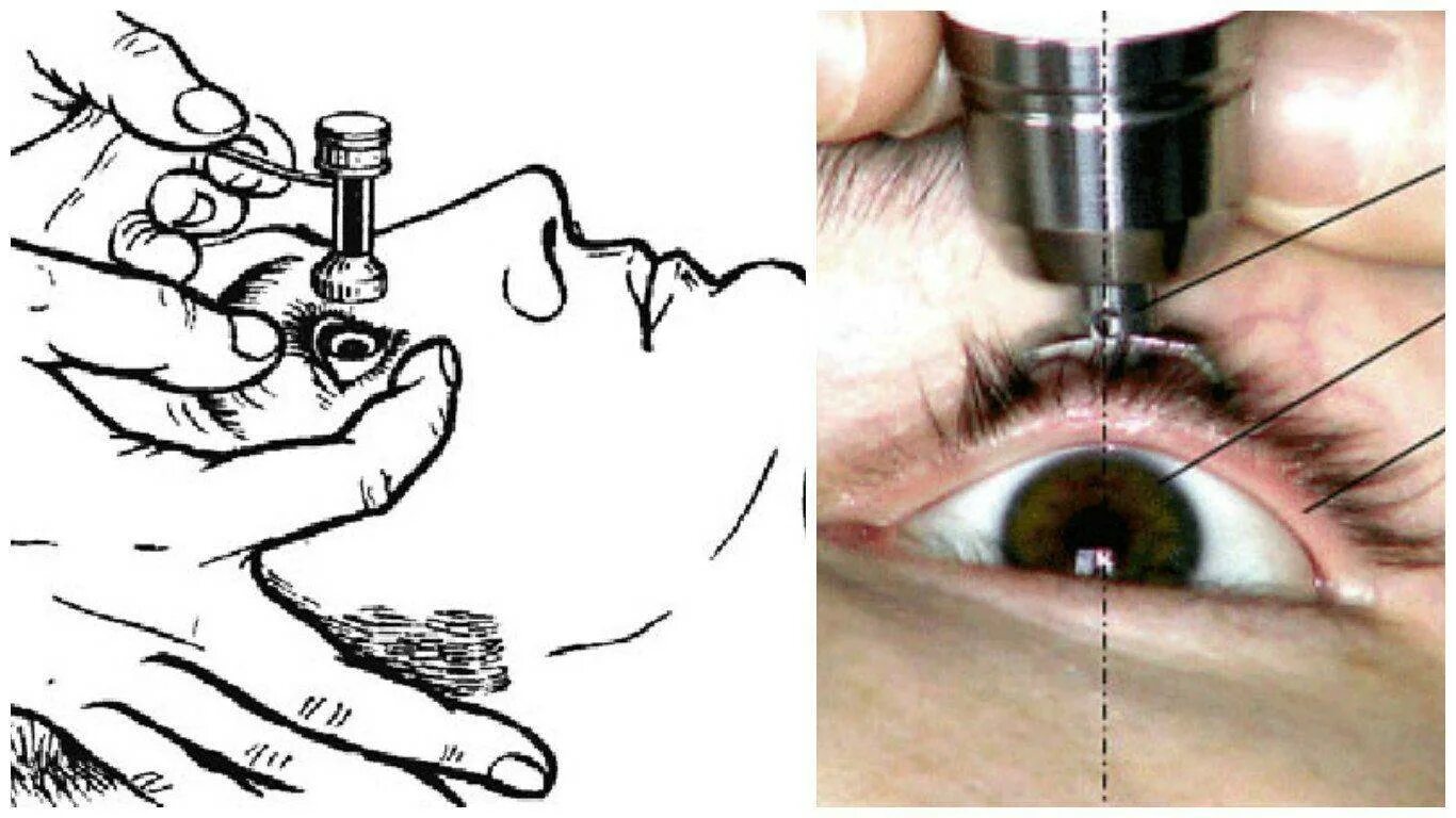Внутриглазное давление по маклакову. Тонометрия метод Маклакова. Измерение ВГД по маклакову. Тонометрия тонометром Маклакова. Тонометрия (измерение глазного давления).
