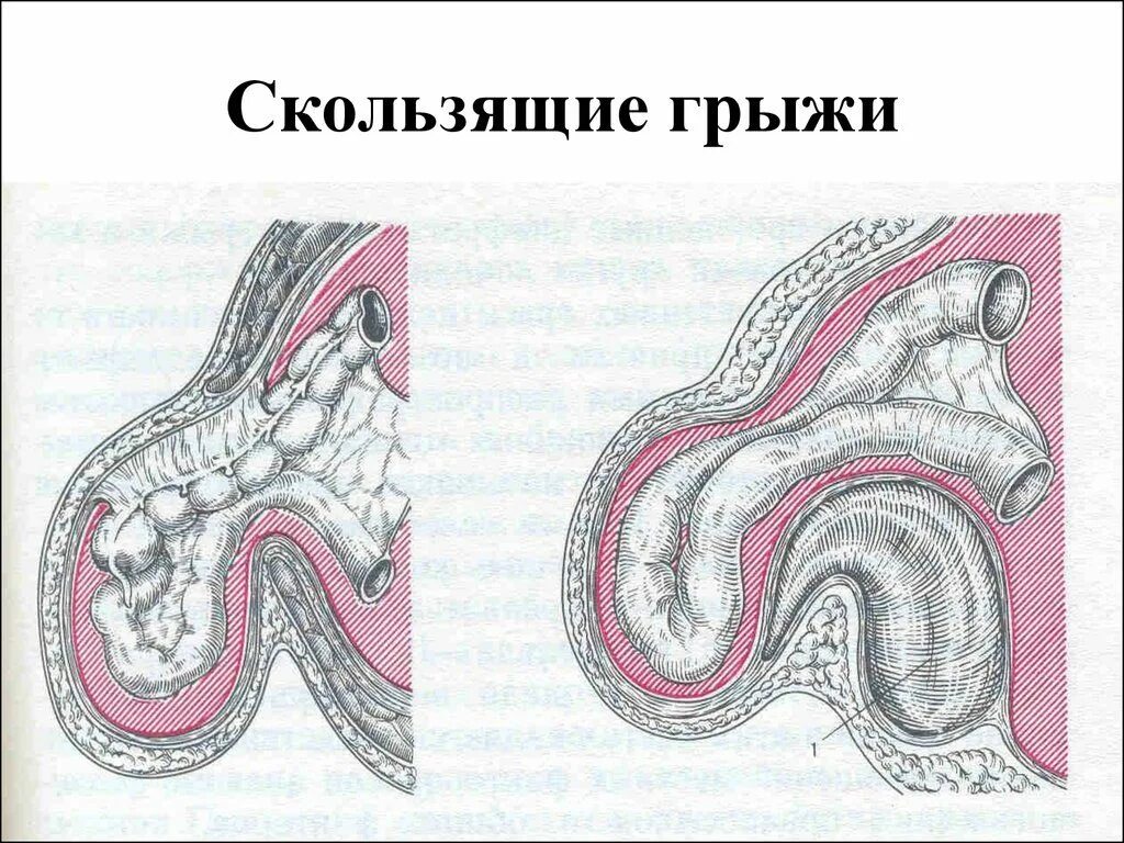 Ущемленная брюшной грыжа. Скользящие грыжи топографическая анатомия. Скользящая паховая грыжа топографическая анатомия. Скользящие грыжи живота. Ущемленная скользящая паховая грыжа.