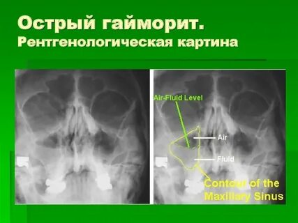 Острый гайморит