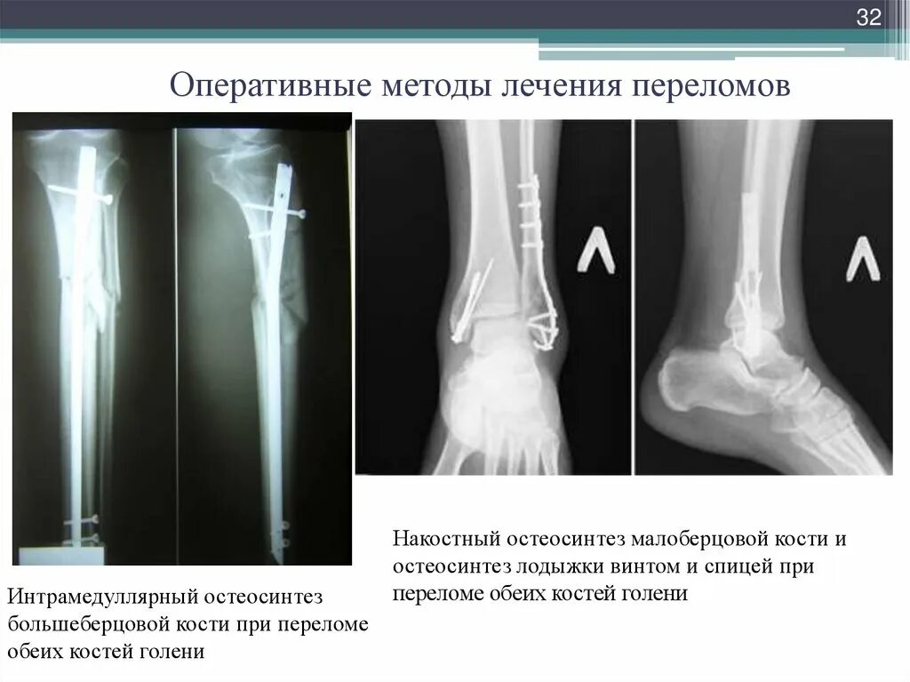 Через сколько срастается кость. Интрамедуллярный остеосинтез большеберцовой кости. Накостный остеосинтез большеберцовой кости. Остеосинтез шурупом рентген. Перелом большеберцовой кости рентген.