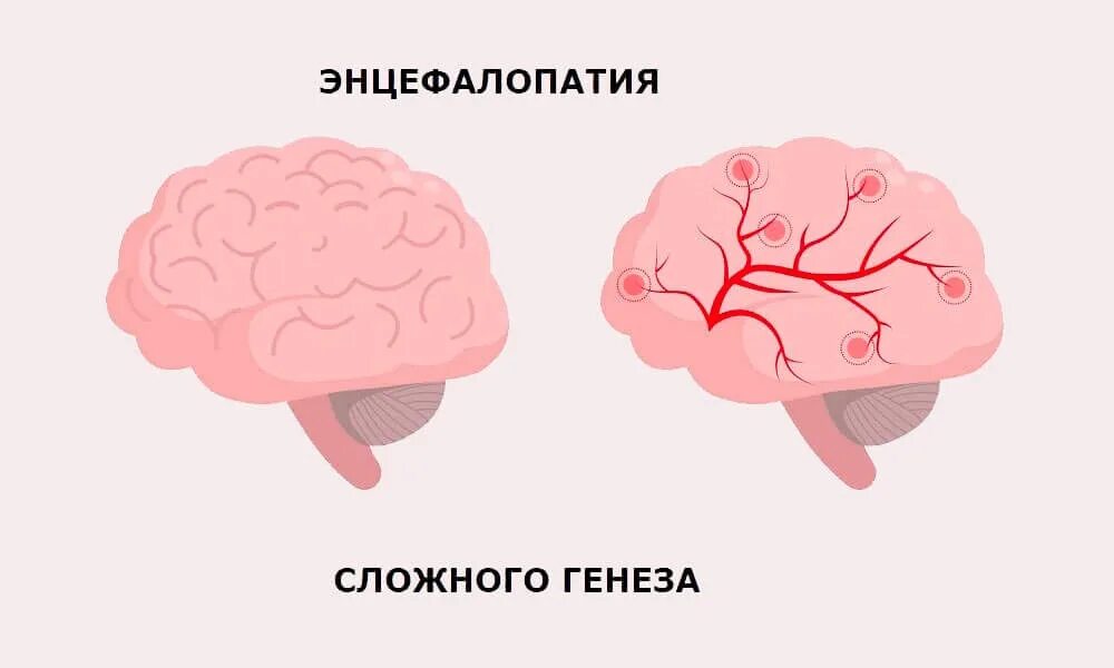 Тяжелые поражения мозга. Энцефалопатия сложного генеза. Энсефалапатиясложного Гегеза. Энцелофапатия головного мозга.